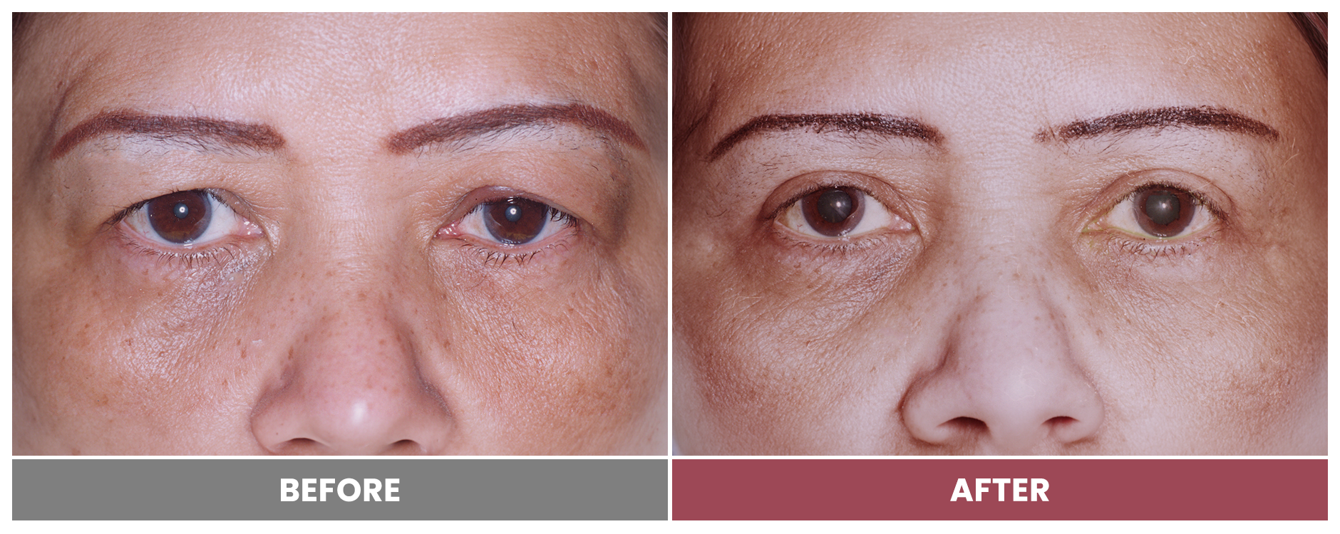 Upper Blepharoplasty - Case 23